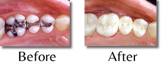 Before and after photos of a patient who had silver amalgam fillings replaced with white composite fillings.