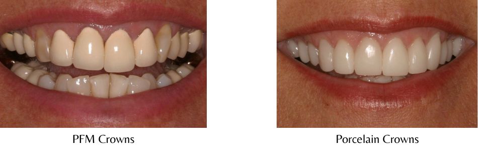 A side-by-side comparison of a patient's smile with PFM crowns and with new porcelain crowns.