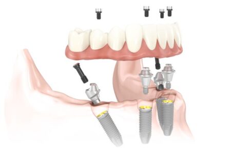 Rendering of a lower denture being attached to four dental implants that were placed with the All-on-4 method.