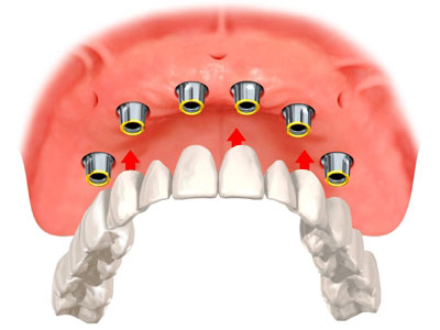 3-D rendering of an implant bridge being attached to the upper jaw through 6 dental implants.