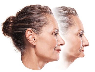 Rendering of a woman's face shows the sinking of the cheeks and shriveling of the chin that occurs as a result of facial collapse.
