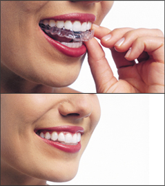 Top and bottom photos of a woman's smile both as she inserts her clear orthodontic aligner and after it is inserted.