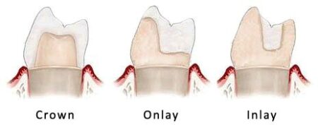 Diagram illustrating the difference between porcelain crowns, onlays, and inlays.