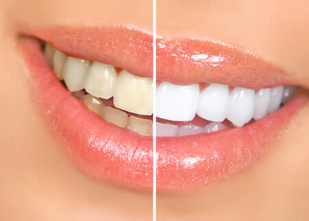 Side-by-side photos of a woman's smile both before and after teeth whitening.